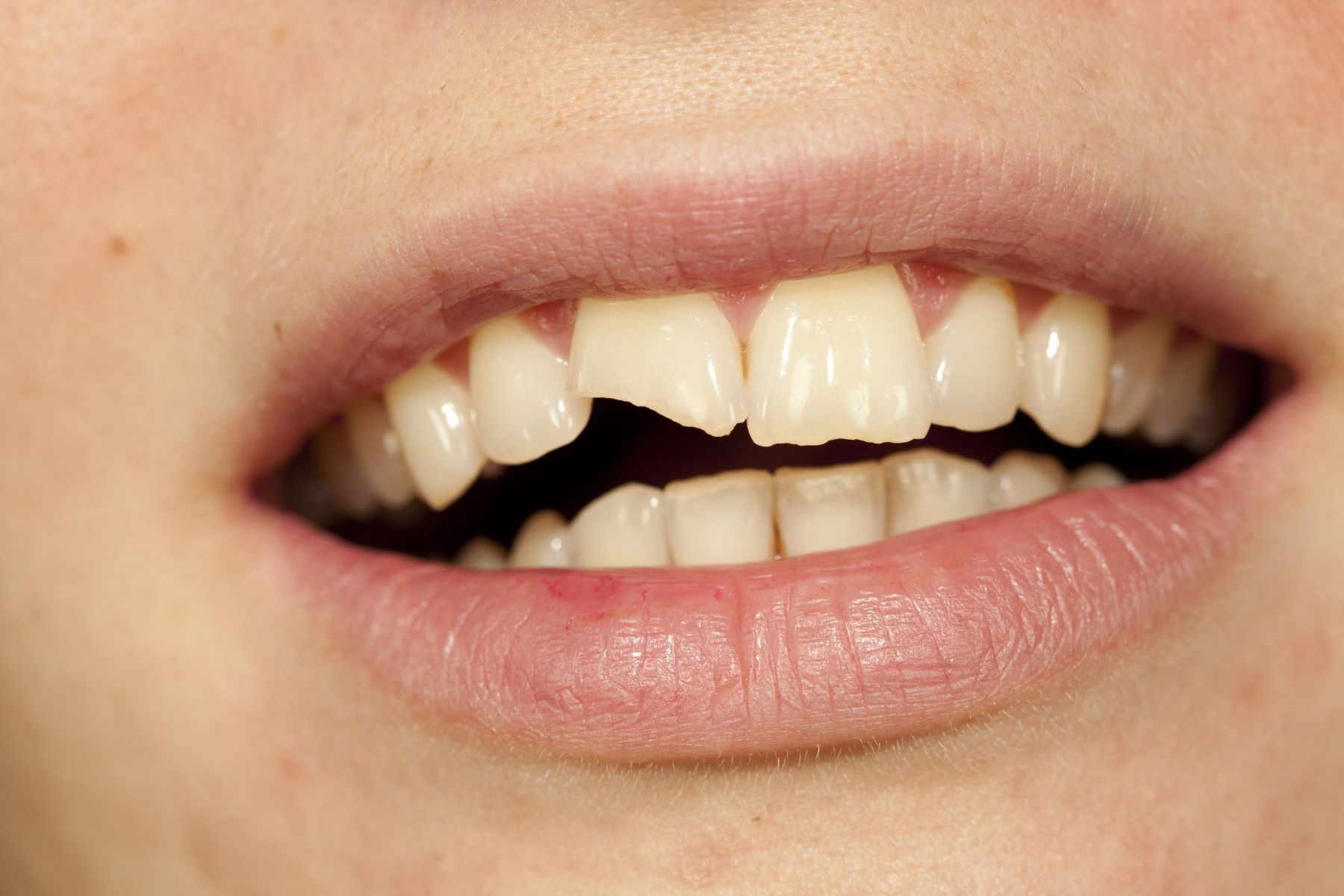 Amazing Natural Remedies To Fix Cracked Front Teeth!