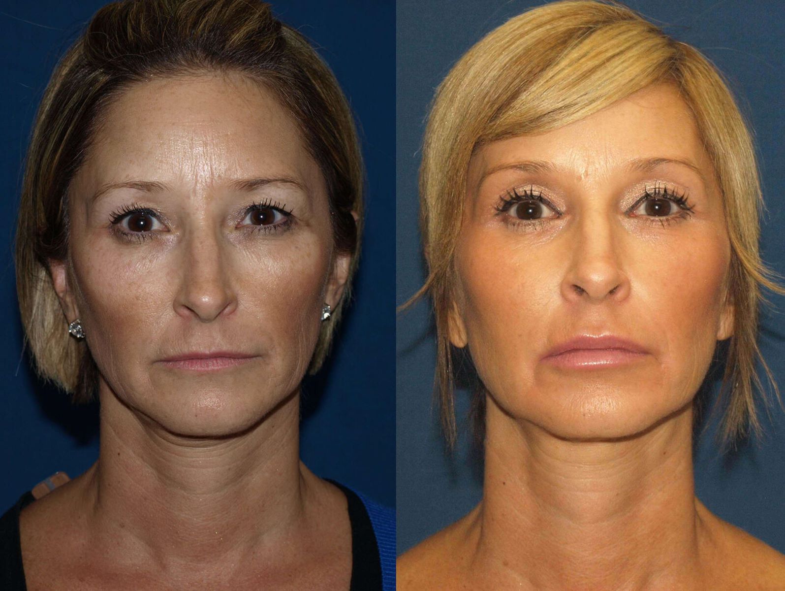 The Shocking Price Of A Liquid Facelift Revealed!