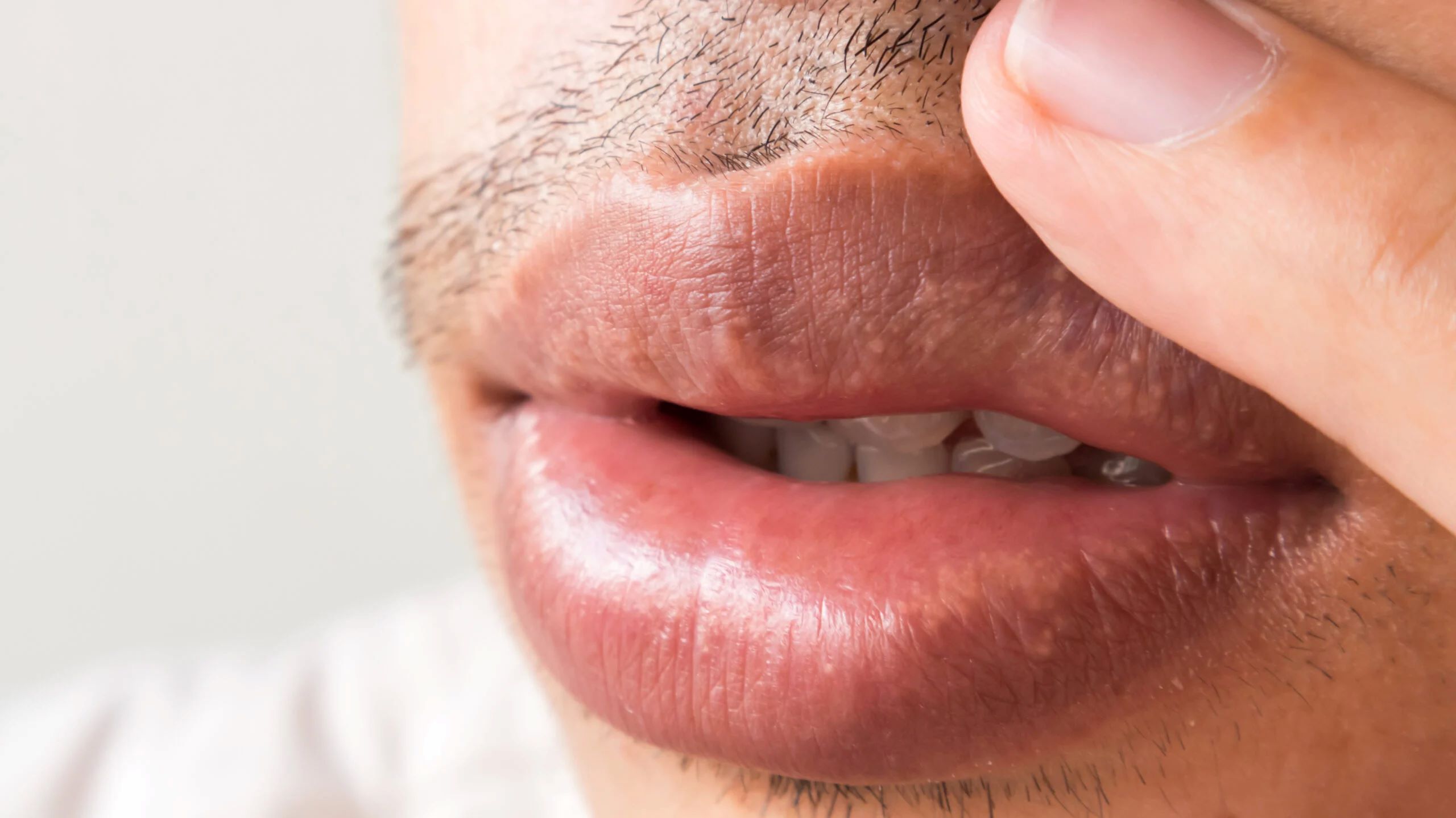 The Surprising Complications Of Exfoliative Cheilitis You Never Knew About