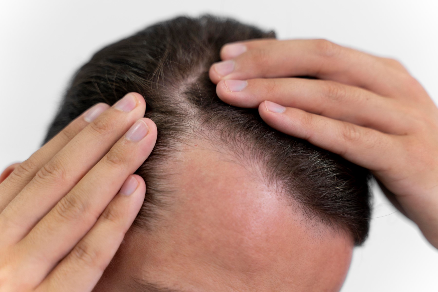 The Truth About Receding Hairlines In 18-Year-Old Males: How To Stop It Now!