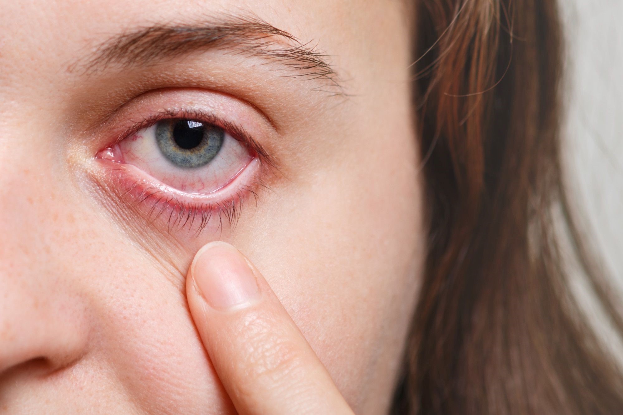 Causes And Differentiating Symptoms Of Red Eyes During Cold/Flu Viruses (Pink Eye)