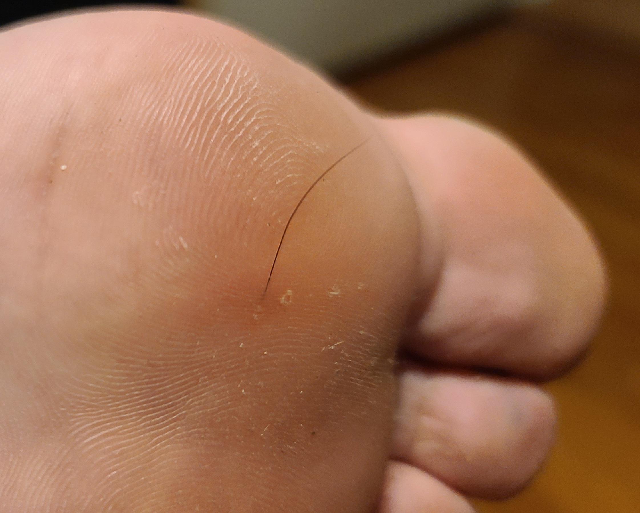 How To Remove A Deep Hair Splinter From Your Foot At Home During Lockdown