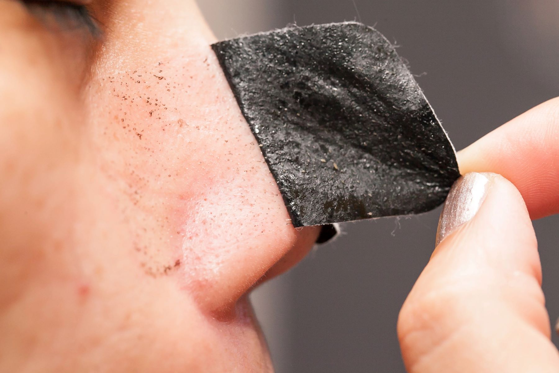 Shocking Video Reveals Enormous Blackhead Growth - You Won't Believe Your Eyes!
