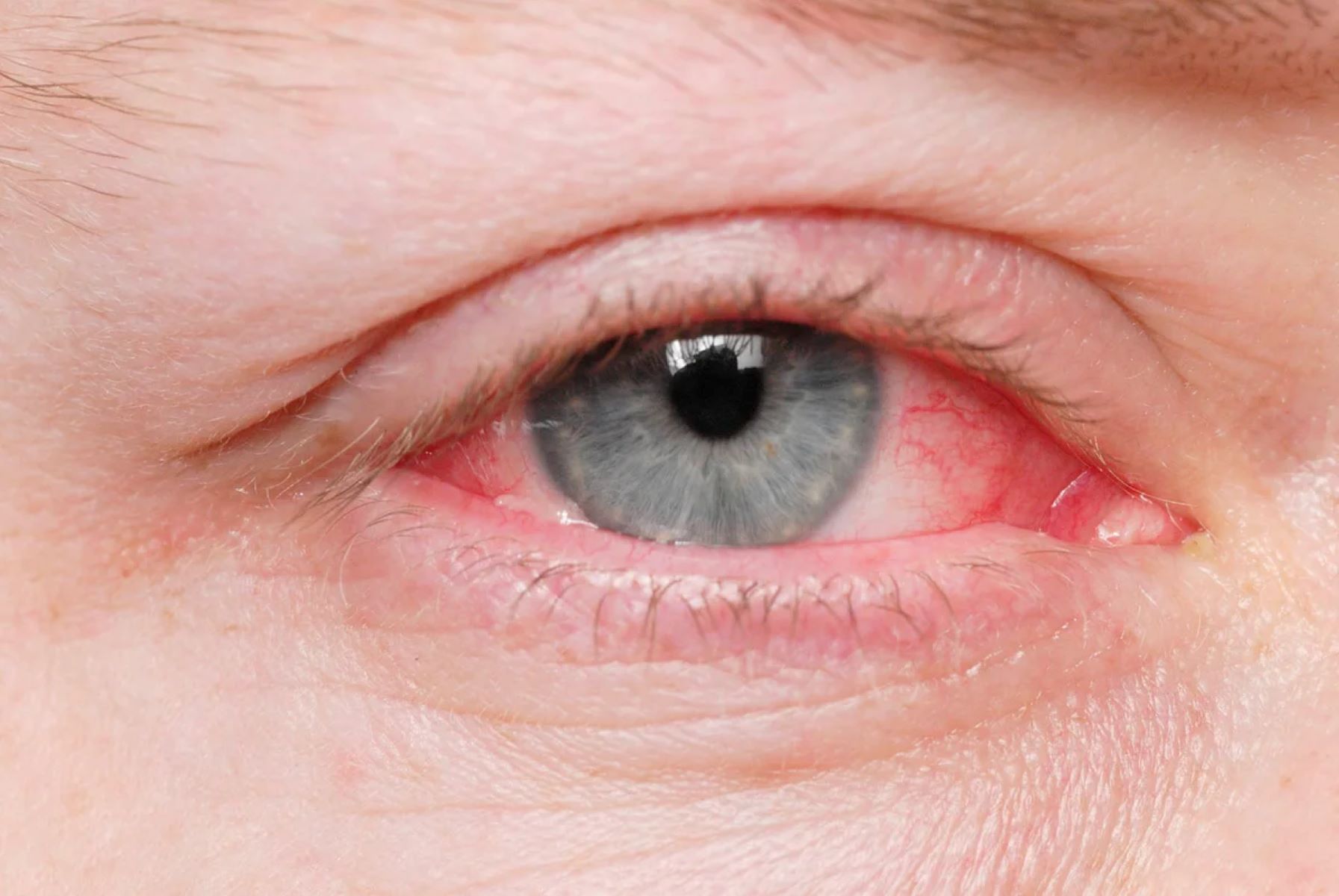 Surprising Way You Could Catch Pink Eye – You Won’t Believe What Happened!