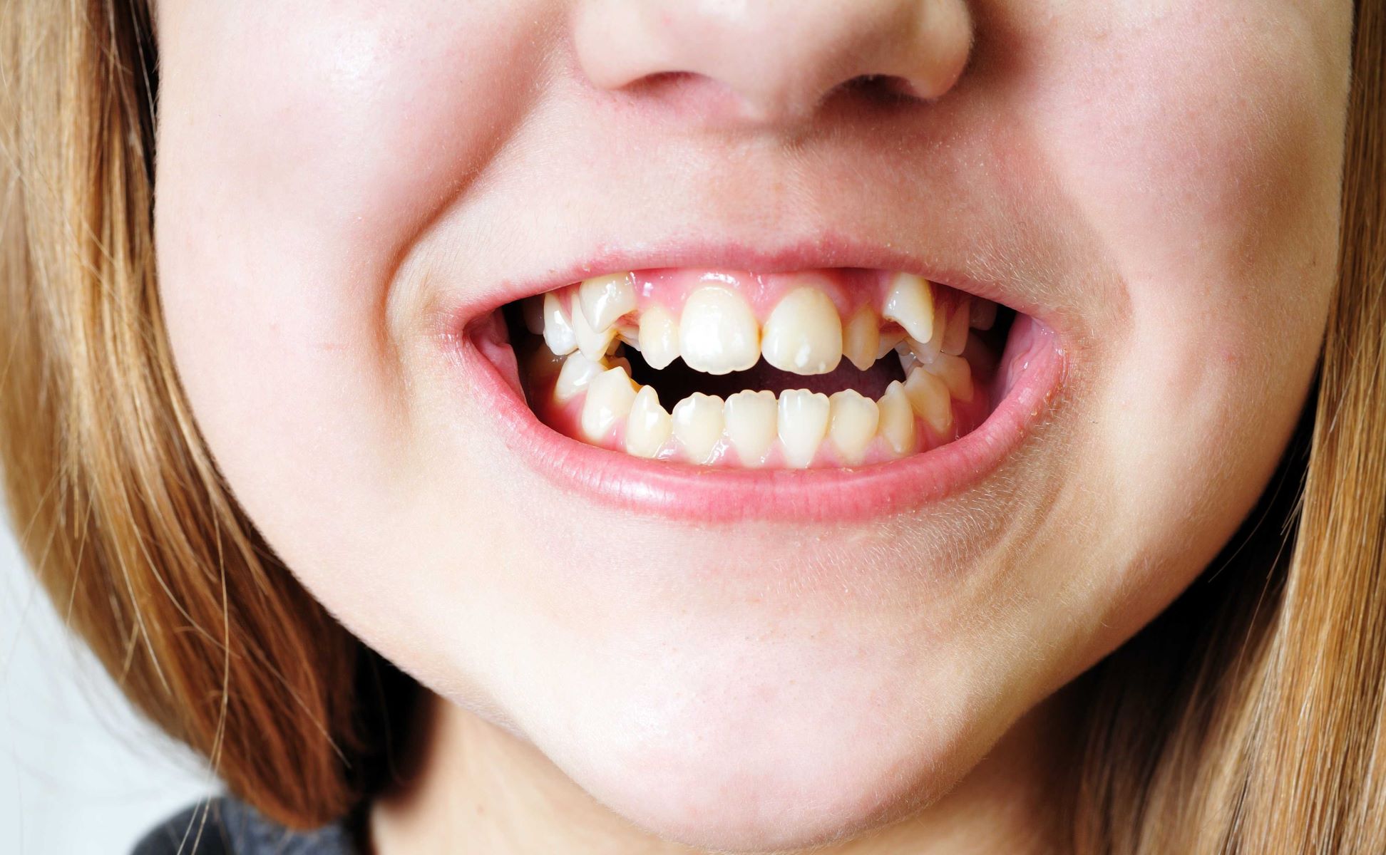 The Shocking Truth: The Startling Reason Behind Brits' Crooked Yellow Teeth!