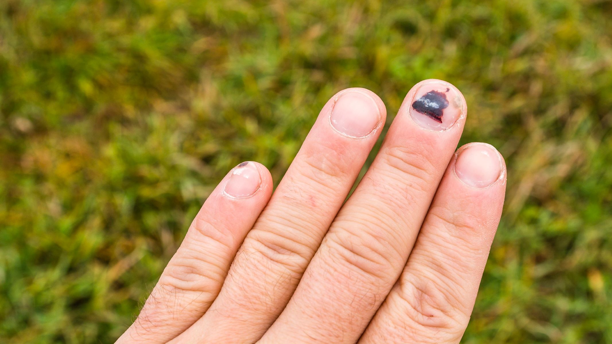 Understanding The Causes Of Persistent Nail Discoloration And Skin Purpling