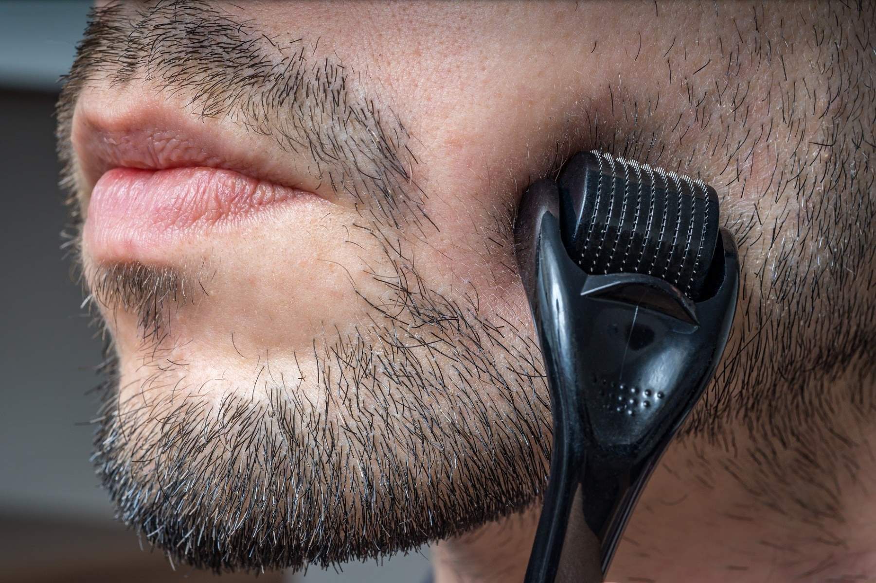 Unleash Your Beard’s Full Potential With Derma Roller – No Minoxidil Required!